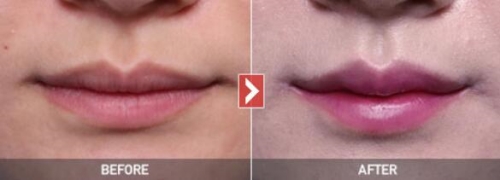 M唇整形手术效果对比