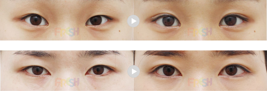 韩国芙莱思整形外科双眼皮案例对比图