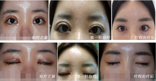 韩国ACE整形外科双眼皮修复案例恢复图