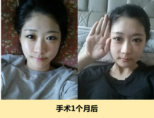 韩国ID下颌角整形术后一个月