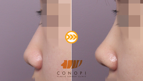 韩国高诺鼻整形外科隆鼻案例对比