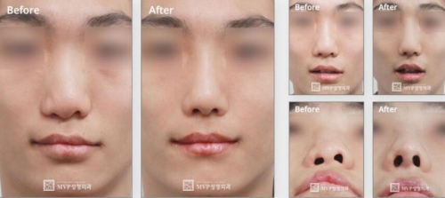 韩国MVP唇腭裂鼻部手术对比效果