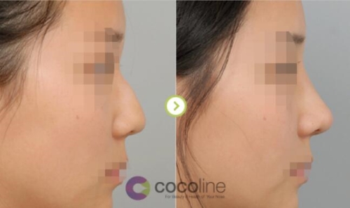 cocoline隆鼻效果对比