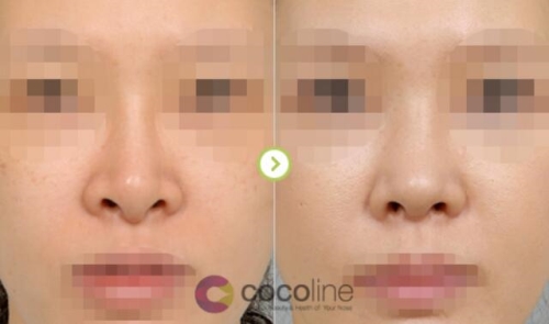cocoline鼻修复效果对比