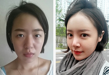 韩国秀美颜整形外科双眼皮修复案例对比