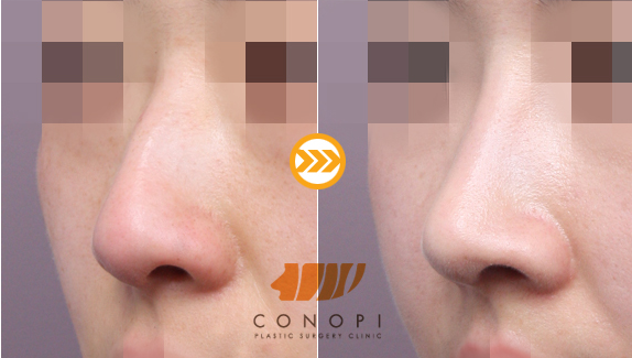 韩国史丹利CONOPI鼻部整形案例
