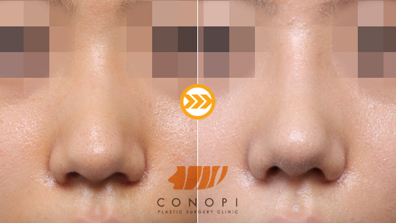 韩国史丹利CONOPI鼻部整形案例