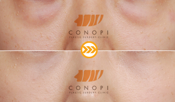 韩国CONOPI高诺鼻眼部整形案例