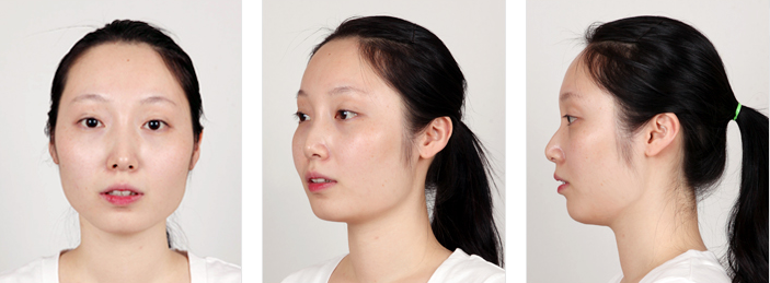 韩国博朗温整形外科四方脸+眼鼻整形 变身时尚女神