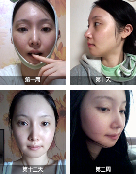 韩国博朗温下颌角整形术后恢复过程