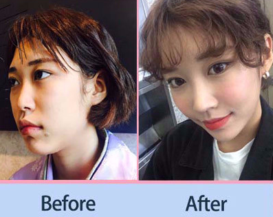 韩国DI隆鼻手术对比案例