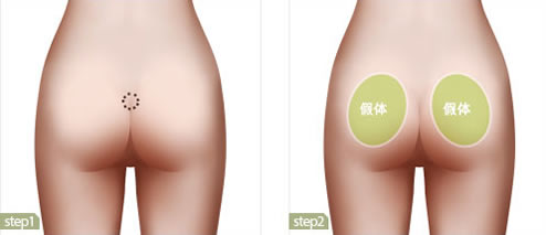 韩国高兰得整形外科臀部整形手术解析