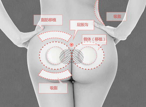 韩国女神医院提臀手术细节展示