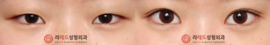 爱琳眼部整形双重开眼角术案例