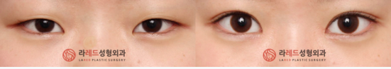 爱琳眼部整形双重开眼角术案例