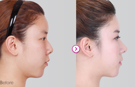 韩国博朗温整形外科鼻整形案例对比
