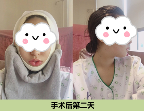 韩国ID整形医院下颌角矫正术后第二天