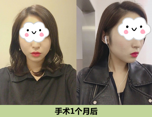 韩国ID整形医院下颌角矫正术后一个月