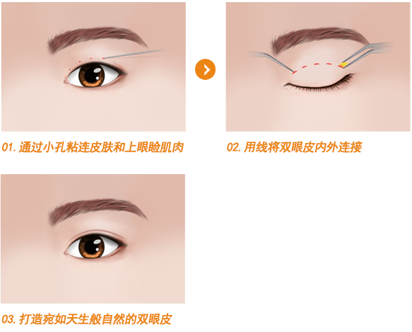 韩国玛博尔整形医院，眼部项目整形案例展示