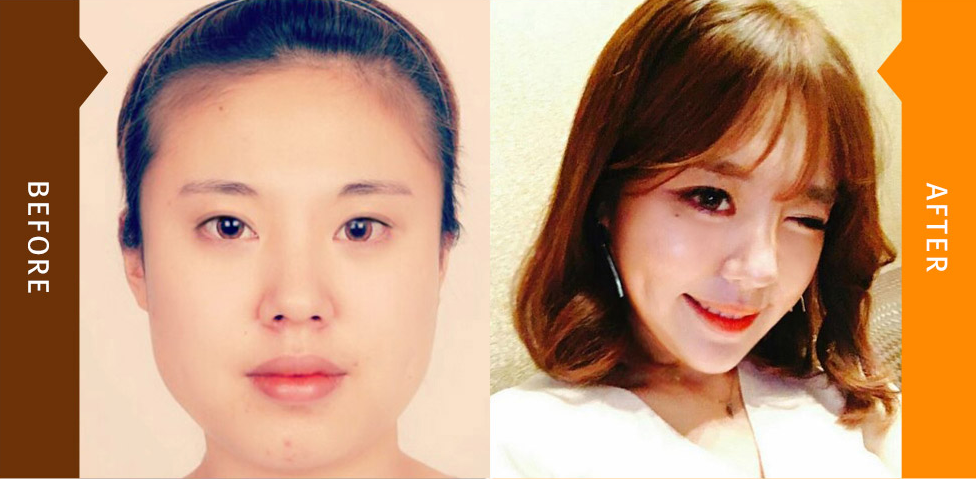 韩国faceline整形外科下颌角整形案例对比