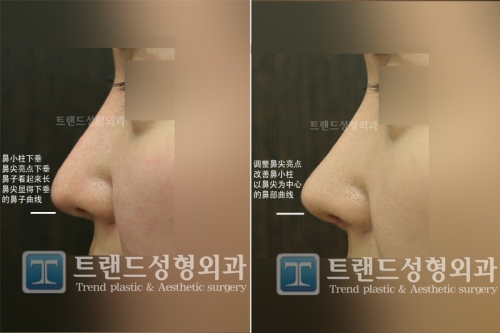 韩国Trend鼻修复术后案例效果