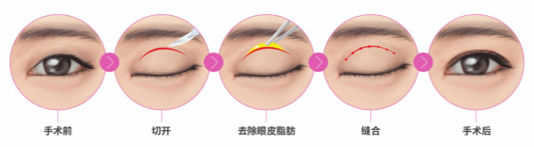 双眼皮手术有几种？埋线法和切开法如何选择？