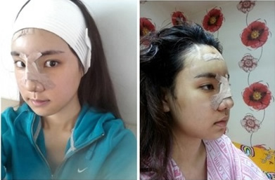 在韩国美之爱整形外科做了面部轮廓整形