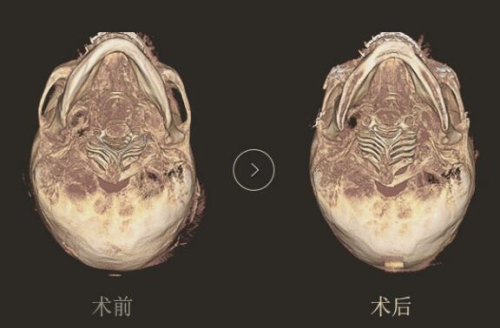 韩国DA整形外科轮廓手术出新篇，颧骨“移动术”有何不同？