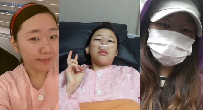 韩国cooki医院真人案例眼鼻整形恢复全过程分享