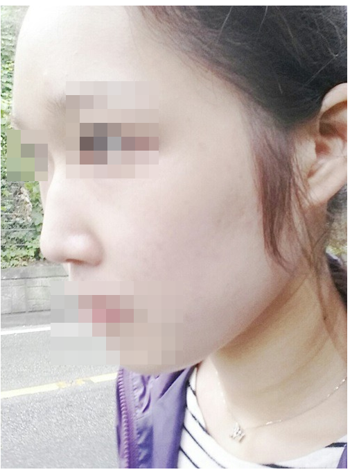 韩国歌柔飞驼峰鼻整形术前照片