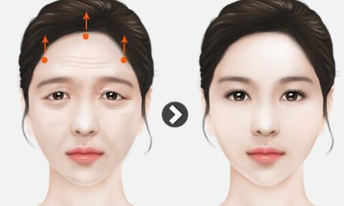 韩国ID医院特色提眉术，打造童颜流行新趋势！