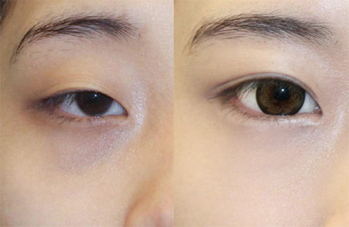 韩国然美之双眼皮+眼型矫正提肌案例图片