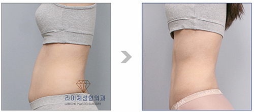 韩国然美之整形腰腹吸脂案例对比图