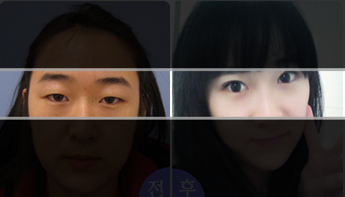 韩国美自人医院双眼皮案例对比
