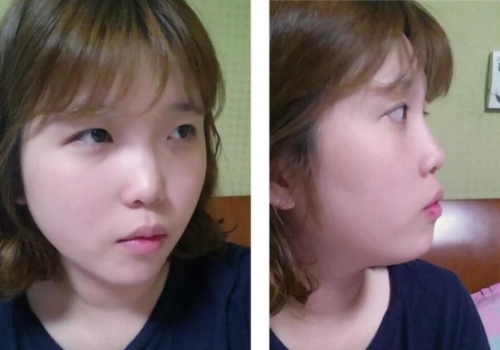 整形后记：韩国然美之鼻综合术后恢复期真实日记展示！
