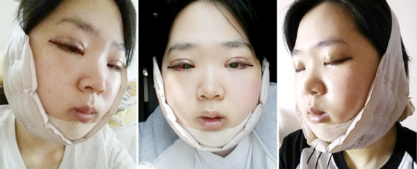 韩国灰姑娘医院双鄂整形手术恢复日记！
