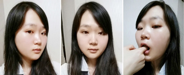 韩国灰姑娘医院双鄂整形手术恢复日记！