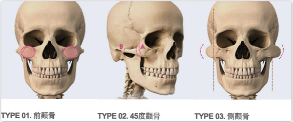 韩国GNG颧骨手术术前3次元分析