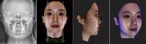 GNG颧骨手术术前3D-CT分析