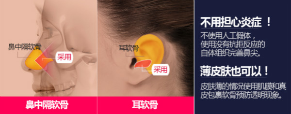 韩国GNG鼻尖抬高术使用材料