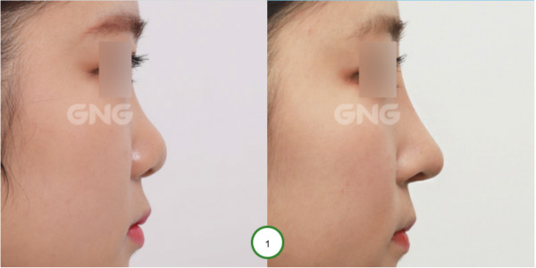 韩国GNG鼻尖抬高手术真人案例