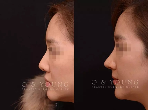 韩国假体隆鼻垫鼻尖案例对比