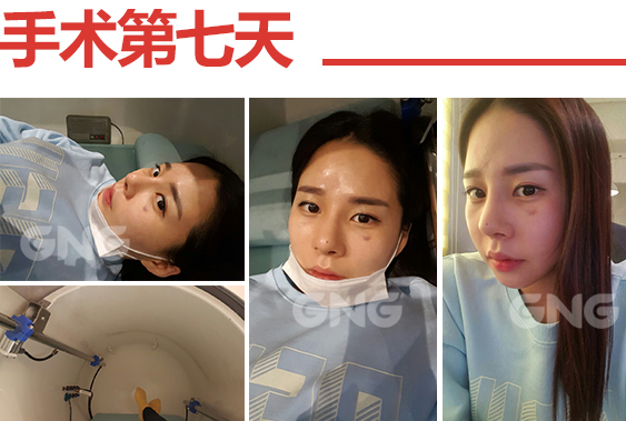 韩国gng鼻尖整形术后恢复一周