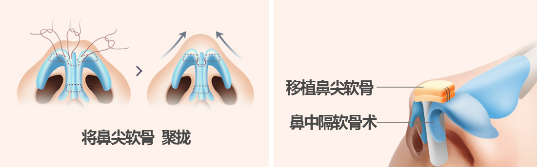 韩国垫鼻尖手术图示
