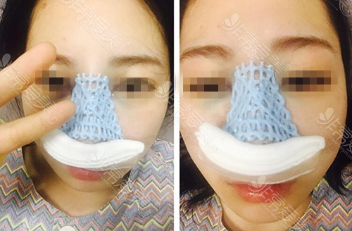 日记图分享：韩国GNG整形医院假体隆鼻恢复过程实例！