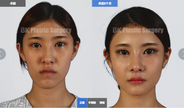 长脸变短有自然方法吗？韩国下巴缩短手术图解分享！