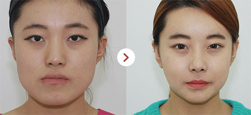 韩国齐娥牙科姜永浩正颌手术前后对比图