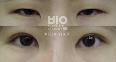 揭秘：韩国BIO医院洪星杓双眼皮修复手术真实日记
