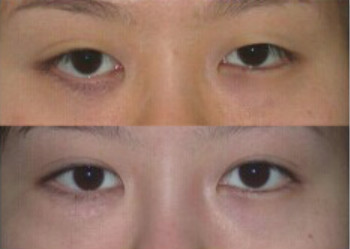 揭秘：韩国BIO医院洪星杓双眼皮修复手术真实案例