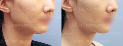 耳后下颌角手术案例对比图